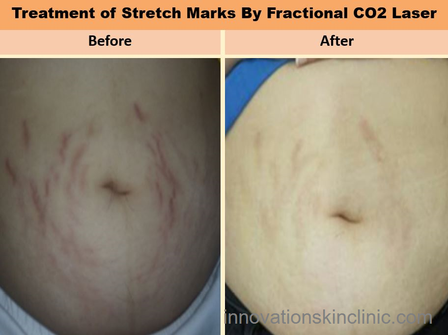 Lasers For Stretch Marks